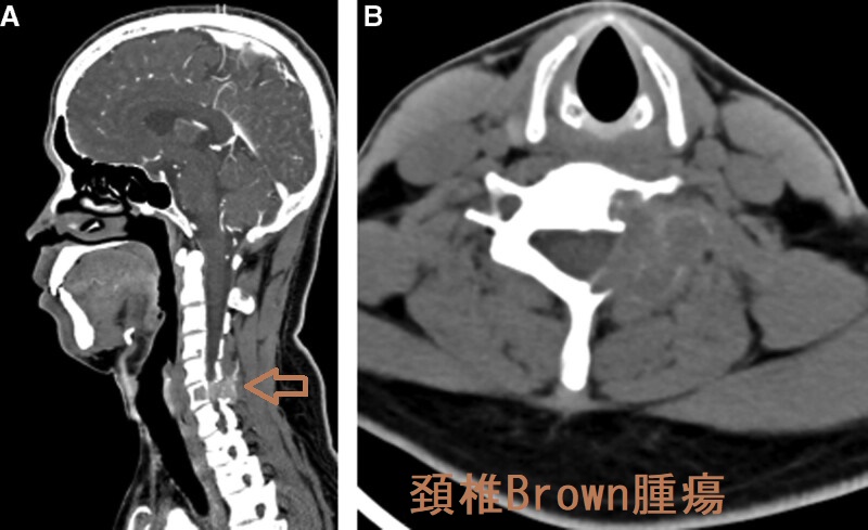 頚椎Brown腫瘍 CT画像