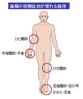痛風結節 好発部位 痛風結節 好発部位
