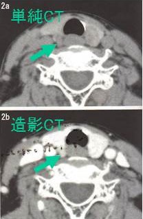 副甲状腺機能亢進症