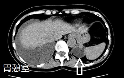 胃憩室CT画像