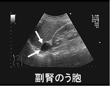 副腎嚢胞（副腎のう胞）超音波(エコー)画像