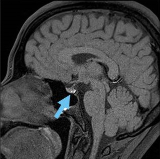ラトケ嚢胞MRI 画像