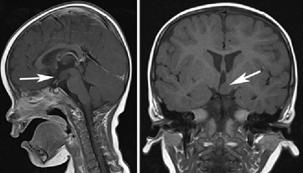 視床下部過誤腫　MRI画像