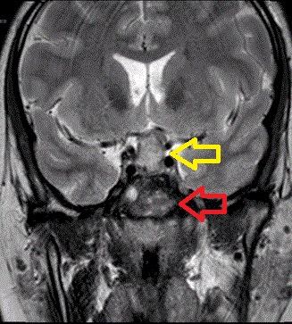 下垂体膿瘍　MRI画像
