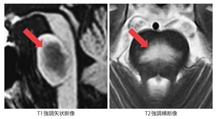浸透圧性脱髄症候群 MRI画像