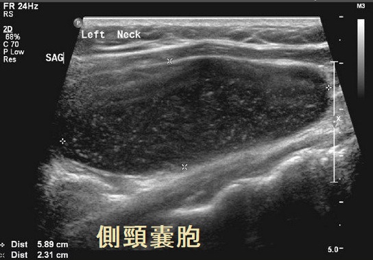 側頸嚢胞 超音波(エコー)画像