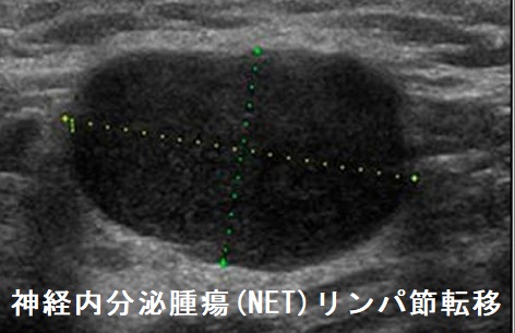 神経内分泌腫瘍 (NET)リンパ節転移 超音波(エコー)画像