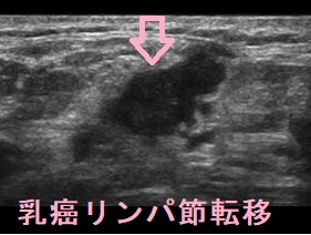 乳癌のリンパ節転移 超音波(エコー)画像
