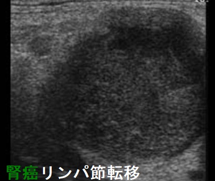 腎癌 リンパ節転移 超音波(エコー)画像