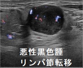 悪性黒色腫 リンパ節転移 超音波(エコー)画像