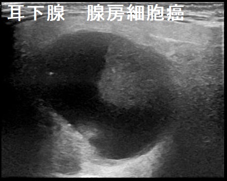 耳下腺 腺房細胞癌 超音波(エコー)画像