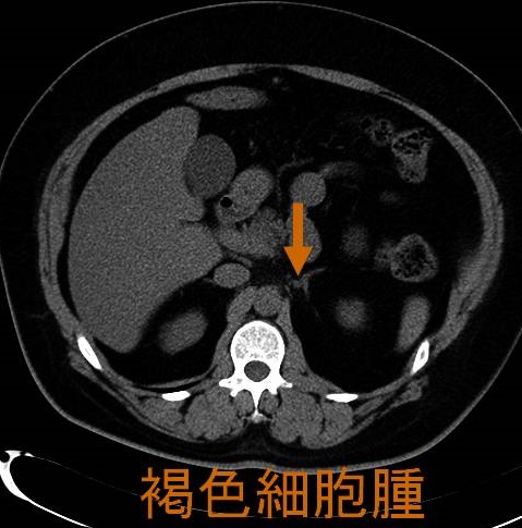 褐色細胞腫 CT画像
