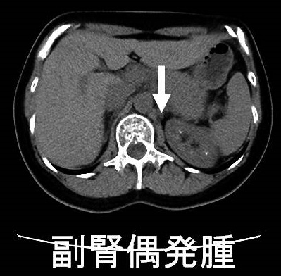 副腎偶発腫瘍（インシデンタローマ）単純CT画像