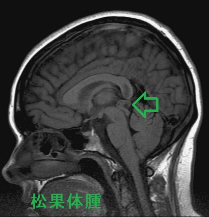 松果体腫　MRI画像