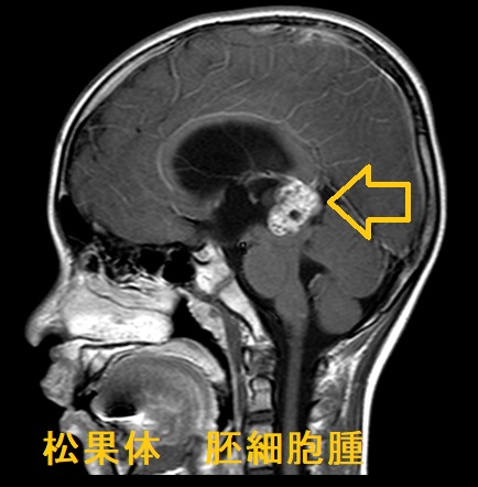 松果体　胚細胞腫　MRI画像