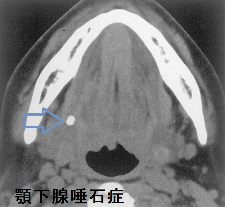 顎下腺唾石 CT画像