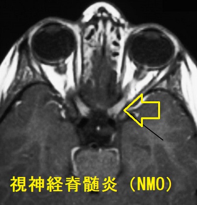 視神経脊髄炎（NMO）/視神経脊髄炎スペクトラム障害（NMOSD）MRI画像