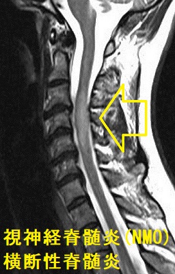 視神経脊髄炎（NMO）/視神経脊髄炎スペクトラム障害（NMOSD）横断性脊髄炎 MRI画像