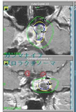 高プロラクチン血症 胃薬