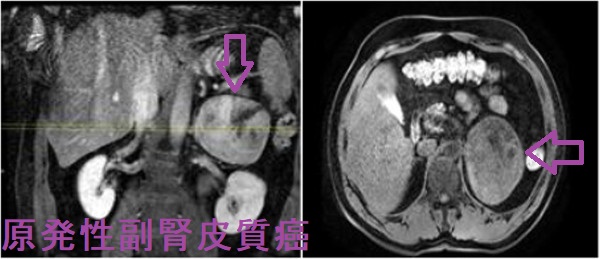 甲状腺乳頭癌に合併した副腎皮質癌（重複癌）MRI画像