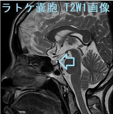 ラトケ嚢胞MRI 画像　T2W1