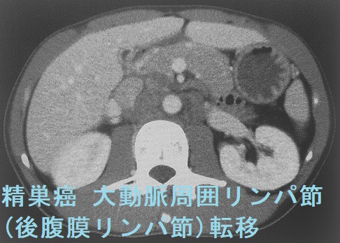 精巣癌 大動脈周囲リンパ節(後腹膜リンパ節)転移 腹部造影CT 精巣癌 大動脈周囲リンパ節(後腹膜リンパ節)転移 腹部造影CT