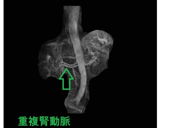 重複腎動脈　MRA画像
