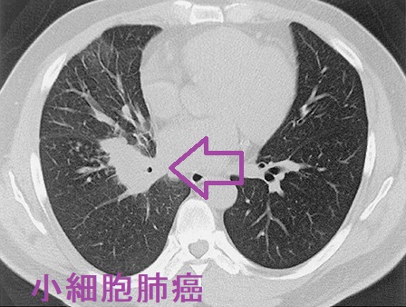 小細胞肺癌   CT画像（肺野条件）