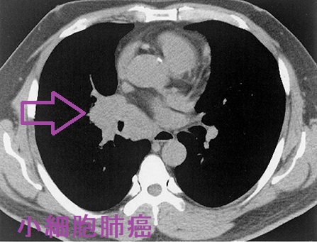 小細胞肺癌   CT画像（肺野条件）