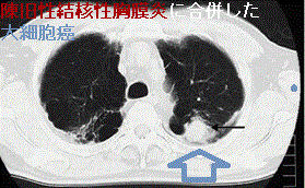 陳旧性結核性胸膜炎に合併した大細胞癌　CT画像
