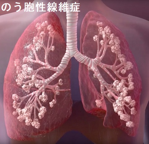 のう胞性線維症の肺