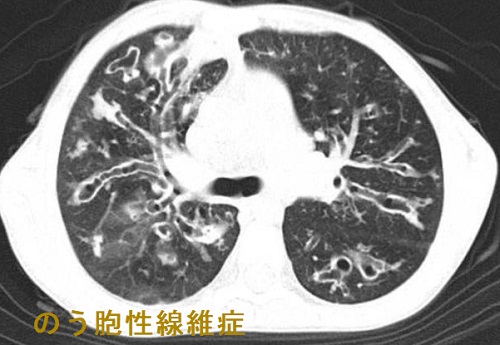 のう胞性線維症 肺CT画像