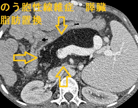のう胞性線維症　膵臓　脂肪置換　CT画像