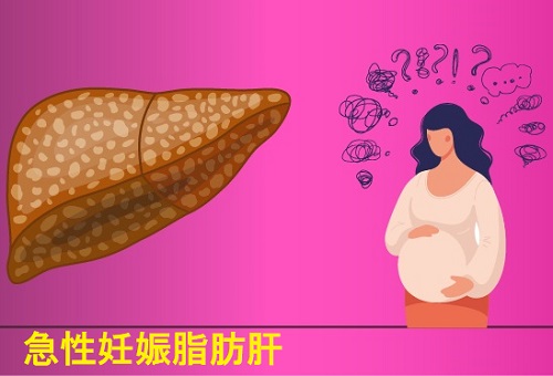 急性妊娠脂肪肝