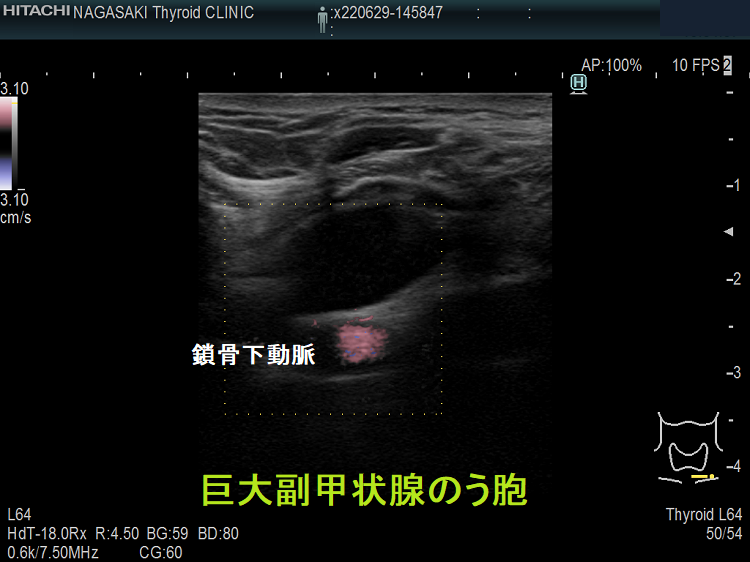 巨大副甲状腺のう胞 (超音波エコー画像 水平断)
