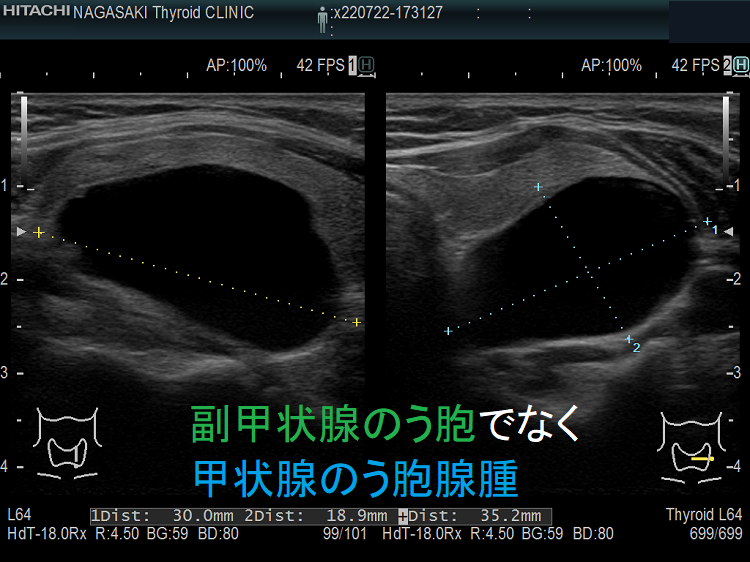 副甲状腺のう胞でなく甲状腺のう胞腺腫 超音波（エコー）画像