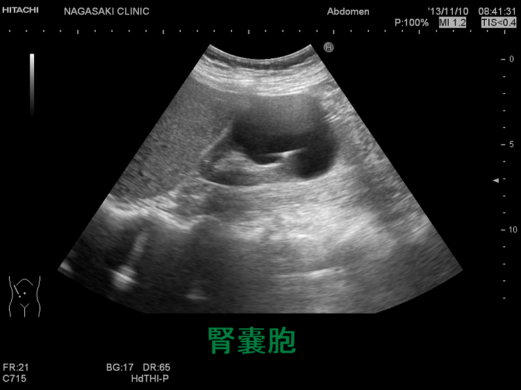 腎嚢胞 超音波(エコー)画像