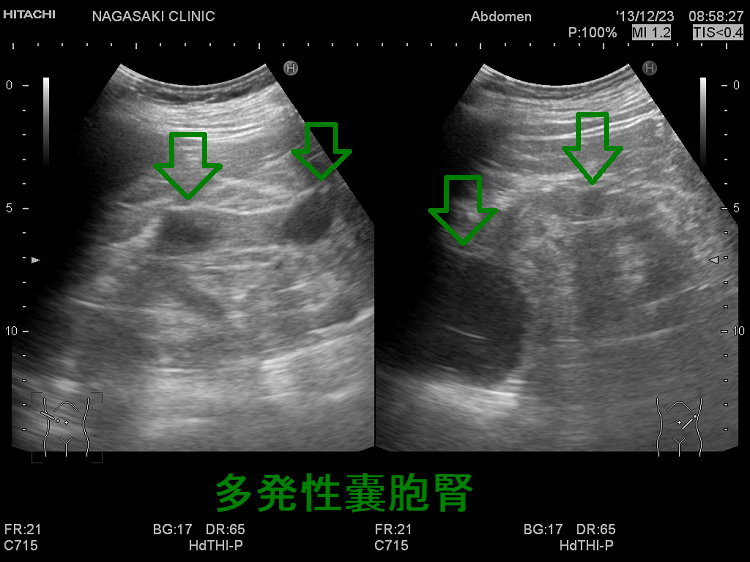 多発性嚢胞腎 超音波(エコー)画像