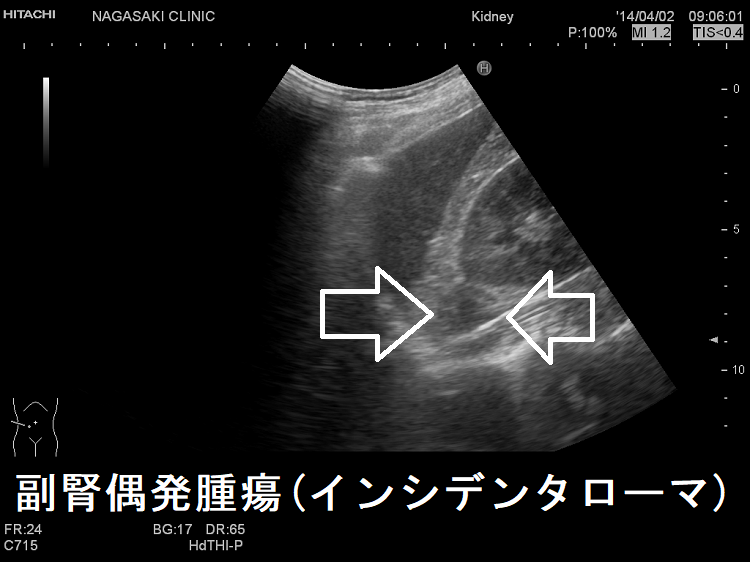 副腎偶発腫瘍（インシデンタローマ）超音波（エコー）画像