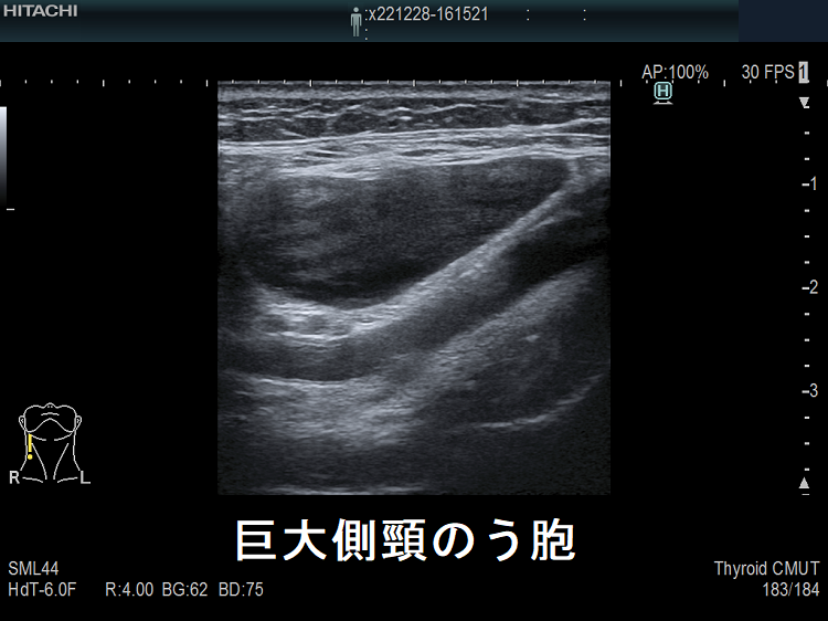 巨大側頸のう胞 超音波(エコー)画像1