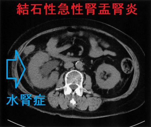 結石性急性腎盂腎炎 水腎症 CT画像