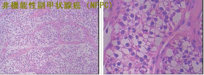 非機能性副甲状腺癌(NFPC)組織像 非機能性副甲状腺癌(NFPC)組織像