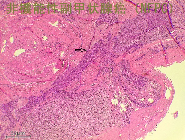 非機能性副甲状腺癌(NFPC)組織像2 非機能性副甲状腺癌(NFPC)組織像2