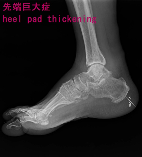 先端巨大症 heel pad thickening 先端巨大症 heel pad thickening