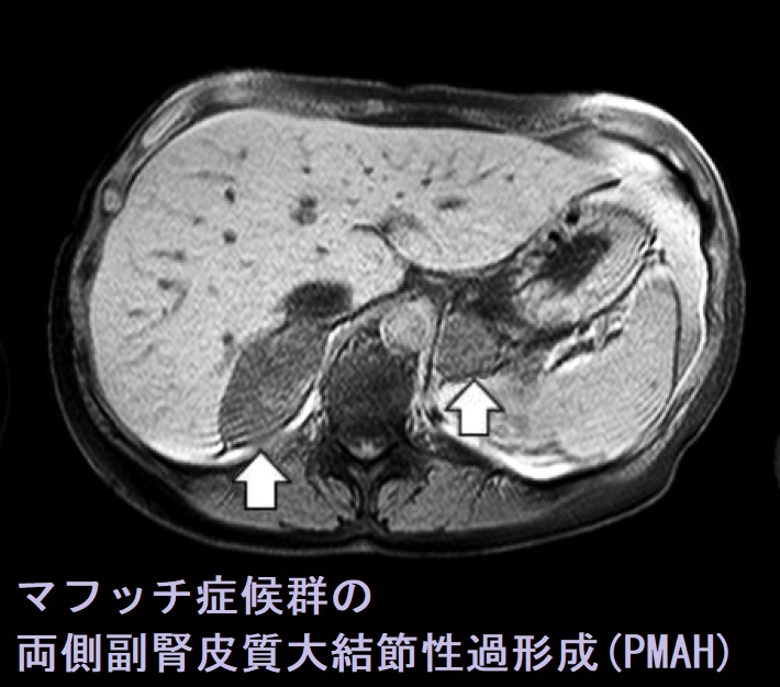 マフッチ症候群に合併した両側副腎皮質大結節性過形成(PMAH) マフッチ症候群に合併した両側副腎皮質大結節性過形成(PMAH)