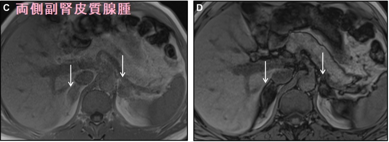 両側副腎皮質腺腫 MRI ケミカルシフト 両側副腎皮質腺腫 MRI ケミカルシフト