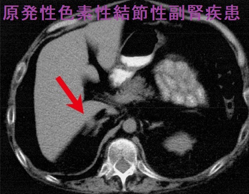 原発性色素性結節性副腎疾患 原発性色素性結節性副腎疾患