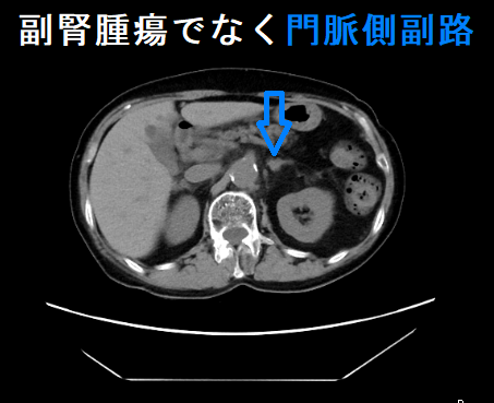 左副腎偶発腫瘍(インシデンタローマ)に見えても、実は門脈側副路 左副腎偶発腫瘍(インシデンタローマ)に見えても、実は門脈側副路