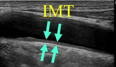総頚動脈内膜中膜肥厚度(CCA IMT)