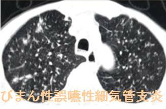 びまん性誤嚥性細気管支炎　肺CT画像